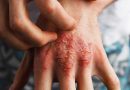 Psoriasis Pustulosa Generalizada: enfermedad de la piel que impacta la salud mental